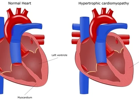 Serious Cardiomyopathy